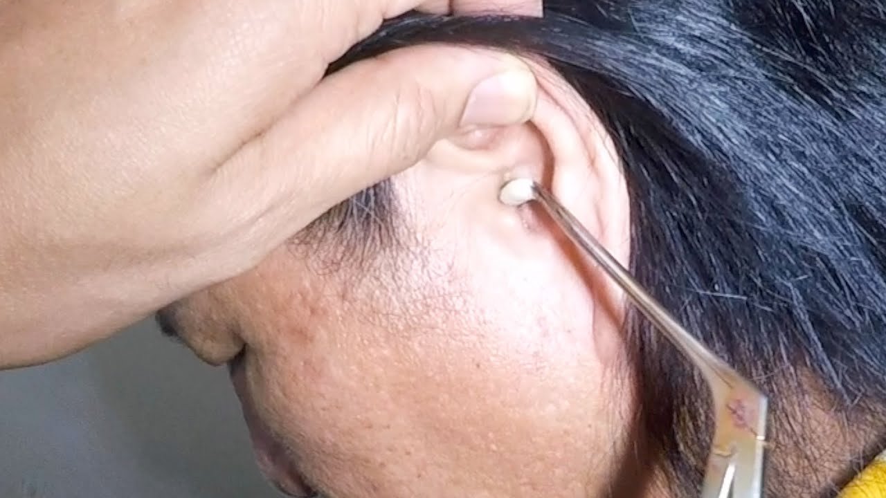 How to Remove Cotton Stuck in Ear at Home Youtube