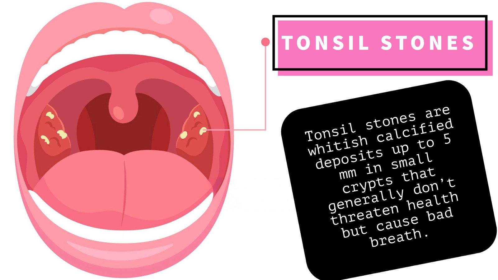 How to Remove Tonsil Stones at Home With Cotton Swab